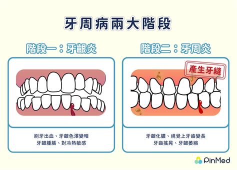 門牙一大一小|門牙縫變大還有救嗎？分析 8 大原因尋求解方！